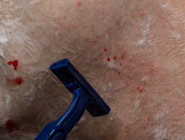 Hassas erkekler cilt closeup, traş jeli ve adam için tek kullanımlık ustura tıraş. Yaralı kan sonra tıraş. Adam sabah