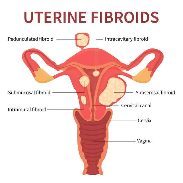 Livmodern fibroider närbild på vit bakgrund — Stock vektor