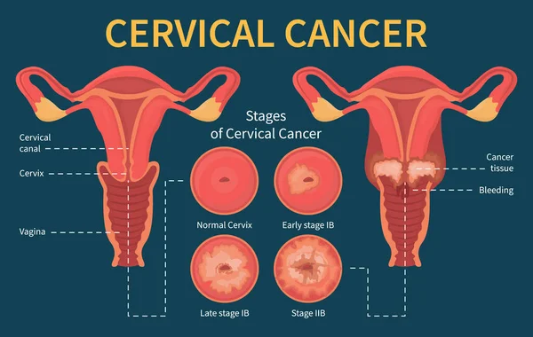 Stages of woman cervical cancer infographic scheme — Stock Vector