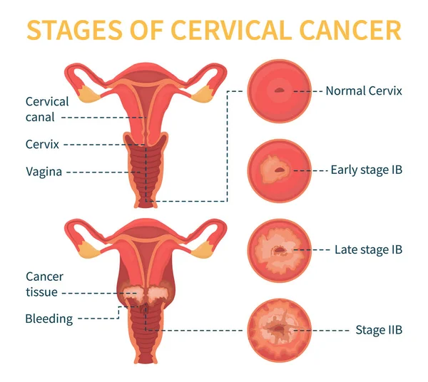 Estadios del esquema blanco del vector del cáncer cervical — Archivo Imágenes Vectoriales