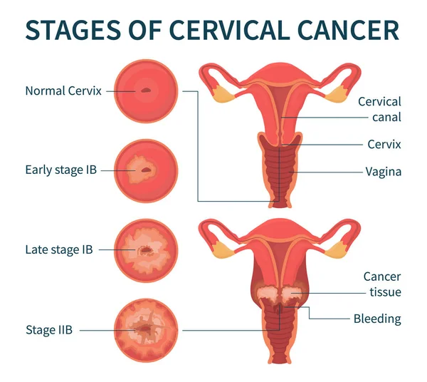 子宫颈癌白人资讯系统的各个阶段 — 图库矢量图片