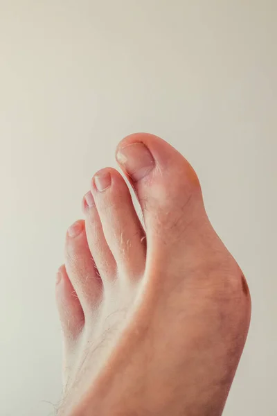 Hässliche Füße Mit Gebrochenem Nagel Und Behaart Mit Großem Zeh — Stockfoto
