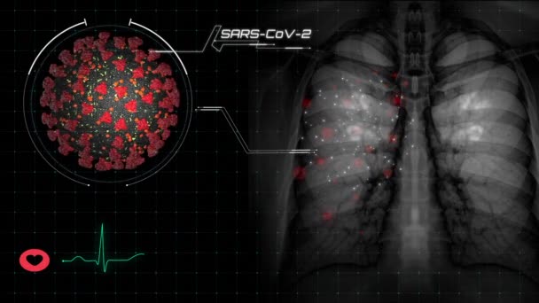 COVID-19, Doença por coronavírus ou infecção por tuberculose na radiografia de tórax pulmonar filme de imagem exibindo doença respiratória de pacientes do sexo feminino saúde na análise de diagnóstico médico — Vídeo de Stock