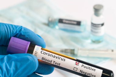 Coronavirus Salgını (COVID-19) için yeni koronavirüs SARS-CoV-2 laboratuvarında el ele tutuşma hastaları kan örnekleri