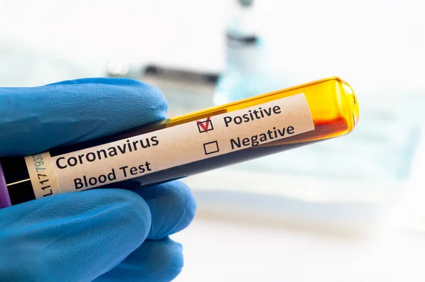 新コロナウイルスSars Cov 2実験室でのコロナウイルス発生 Covid の血液サンプルの手持検査 — ストック写真