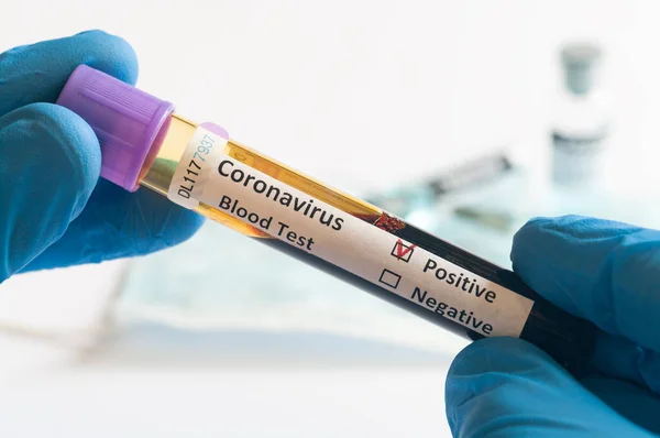 新コロナウイルス2019 Ncov実験室でのコロナウイルス発生 Covid の血液サンプルの手持検査 — ストック写真