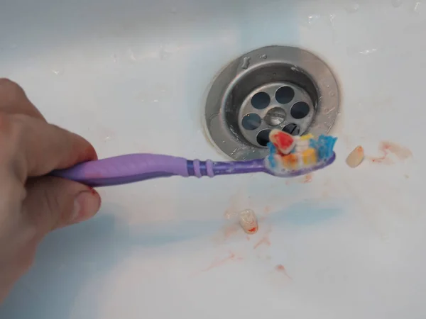 Zahn mit einer blutigen Bürste im Waschbecken. Zahnmedizinisches Konzept — Stockfoto