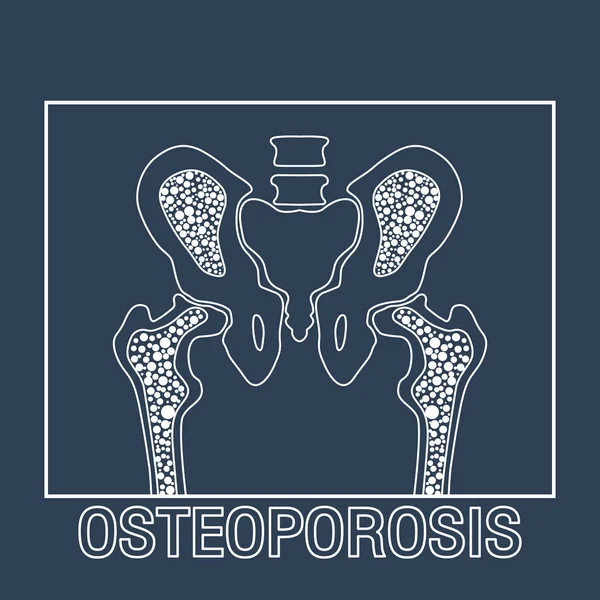OSTEOPOROSIS vector logo icon design — Stock Vector