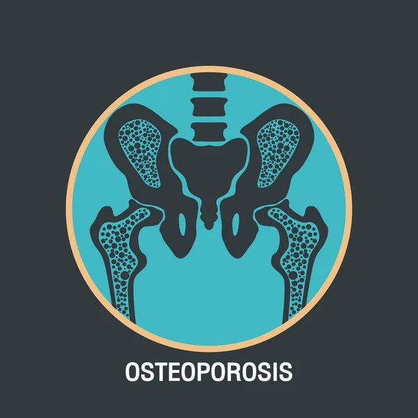 OSTEOPOROSIS vector logotipo icono de diseño — Archivo Imágenes Vectoriales