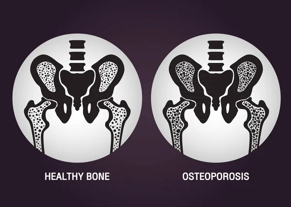 Osteoporose vector logo pictogram ontwerp — Stockvector