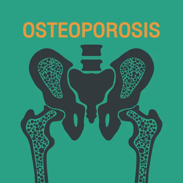 Projeto do ícone do logotipo do vetor OSTEOPOROSIS —  Vetores de Stock