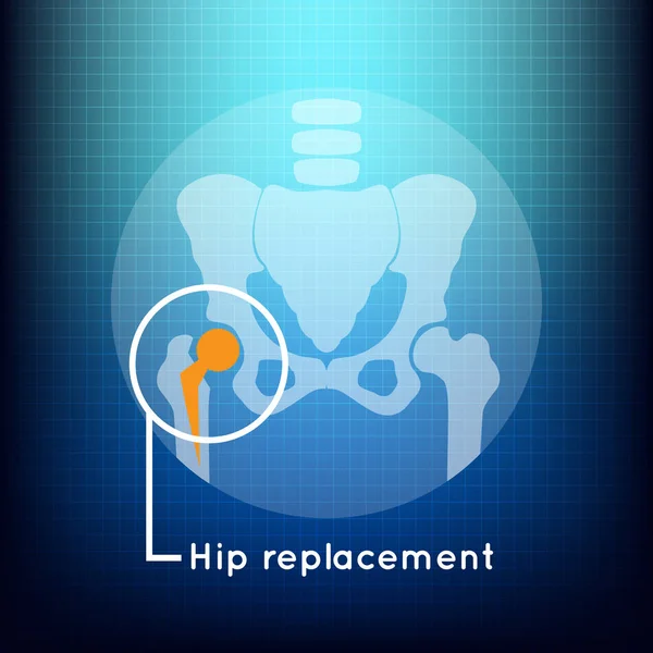 Hip reemplazo logo vector icono de diseño — Archivo Imágenes Vectoriales