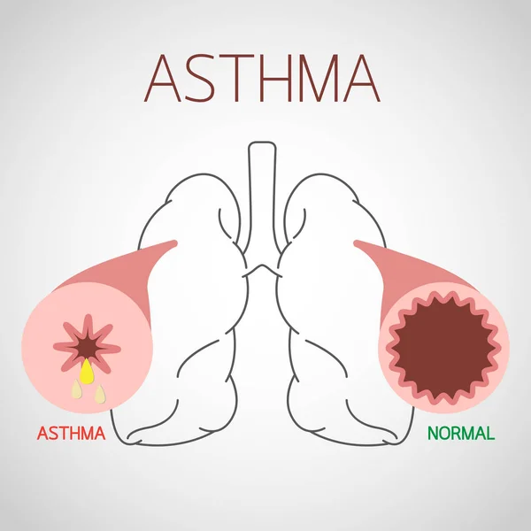 Ilustración del icono del vector del asma — Vector de stock