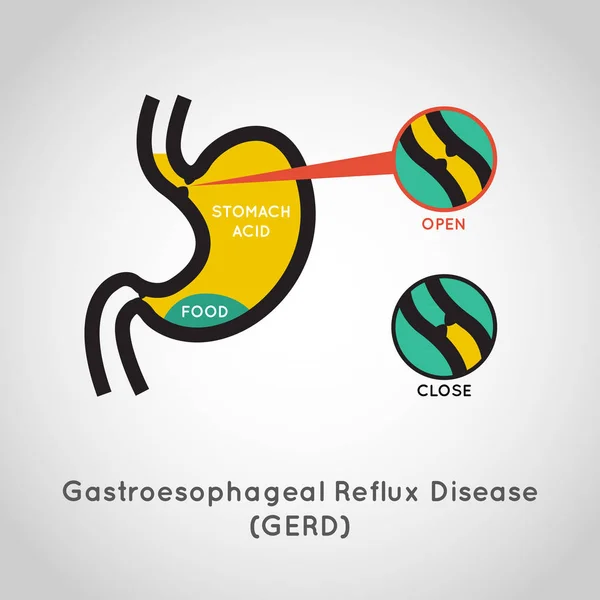 Collecte de vecteurs de la maladie du reflux gastro-œsophagien (RGO) — Image vectorielle