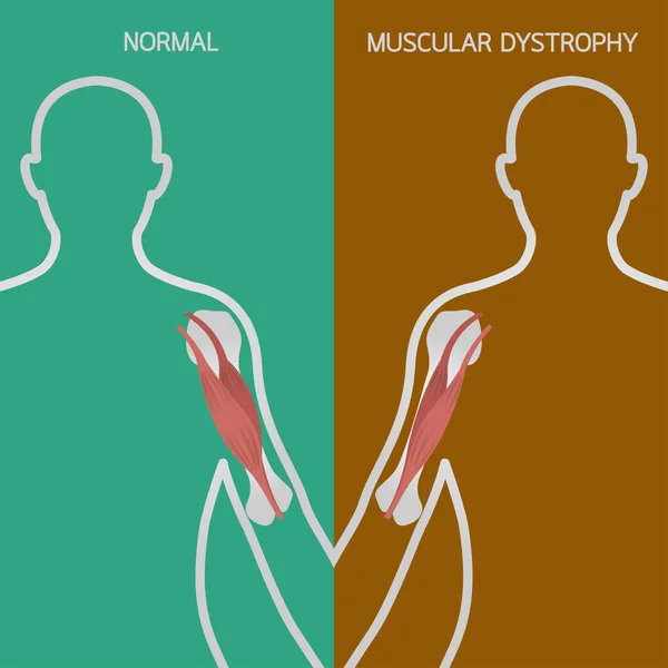 Illustration vectorielle de dystrophie musculaire — Image vectorielle
