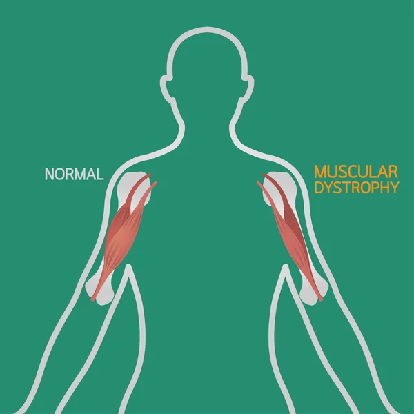 Distrofia muscular vector ilustración — Archivo Imágenes Vectoriales