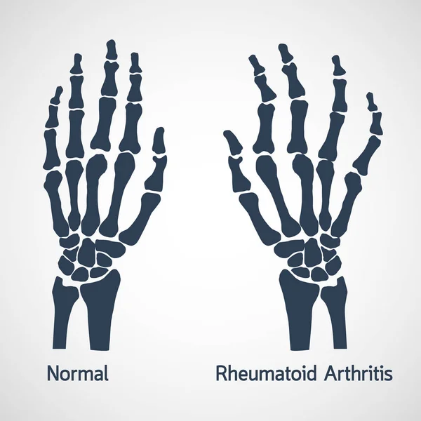 Artritis reumatoide vector icono ilustración — Archivo Imágenes Vectoriales