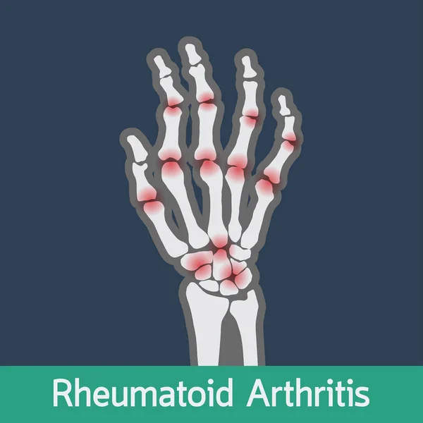 Artritis reumatoide vector icono ilustración — Archivo Imágenes Vectoriales