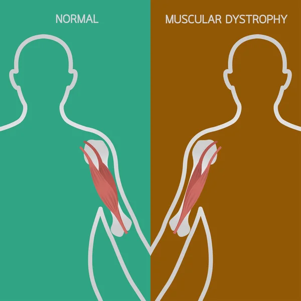Векторная иллюстрация мышечной дистрофии — стоковый вектор
