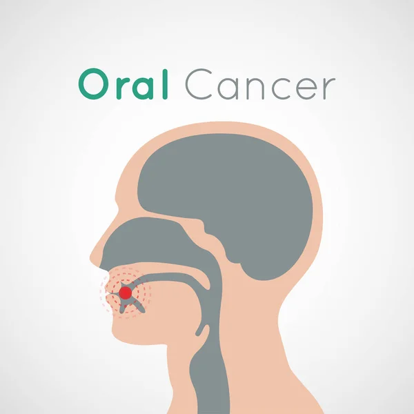 Ilustración de diseño de icono de vector de cáncer oral — Vector de stock