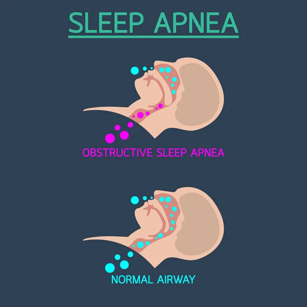 Illustration d'icône vectorielle Apnée du sommeil — Image vectorielle