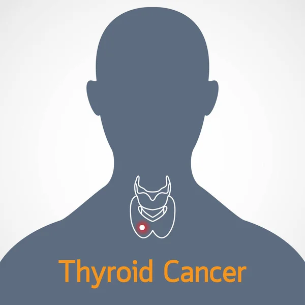 Εικονογράφηση εικονίδιο φορέα του καρκίνου του θυρεοειδούς — Διανυσματικό Αρχείο
