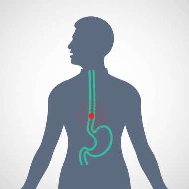 Esophageal Cancer vector logo icon illustration clipart
