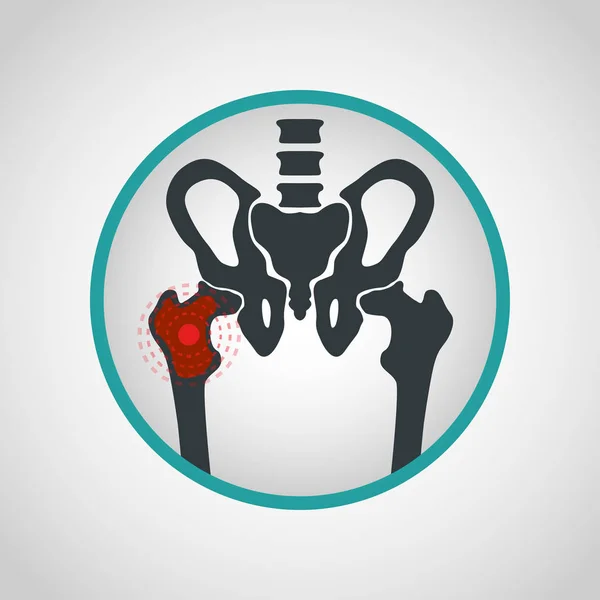 Illustration de conception d'icône vectorielle de logo de cancer d'os — Image vectorielle