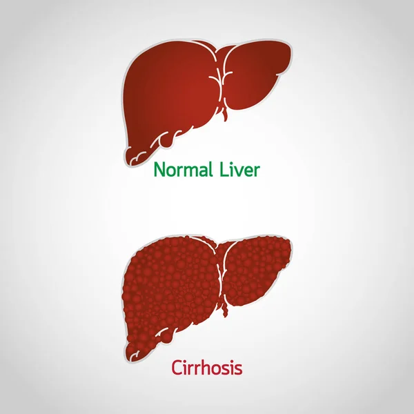 Κίρρωση και εικονογράφηση εικόνα λογότυπο φορέα — Διανυσματικό Αρχείο