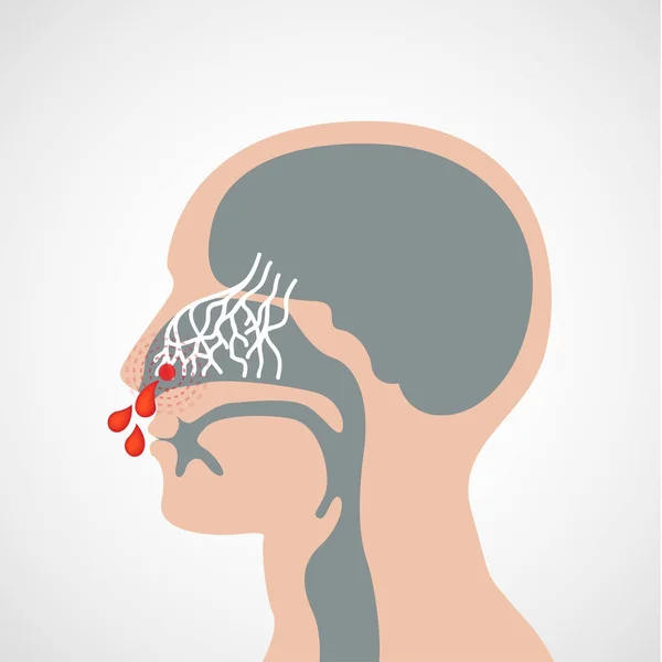 Epistaxis vetor logotipo ícone ilustração — Vetor de Stock