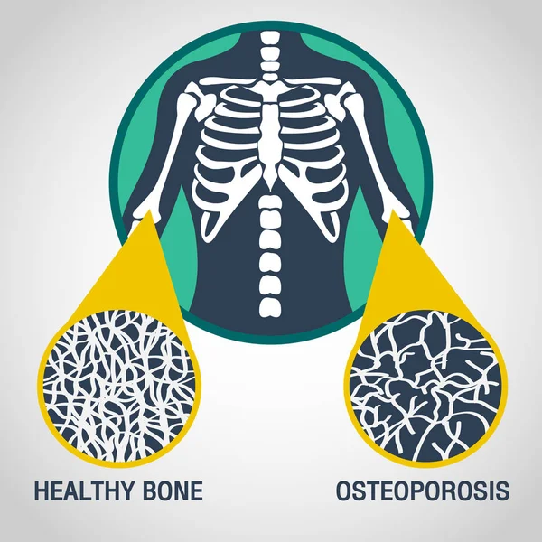 Osteoporosis vector logo icono ilustración — Archivo Imágenes Vectoriales