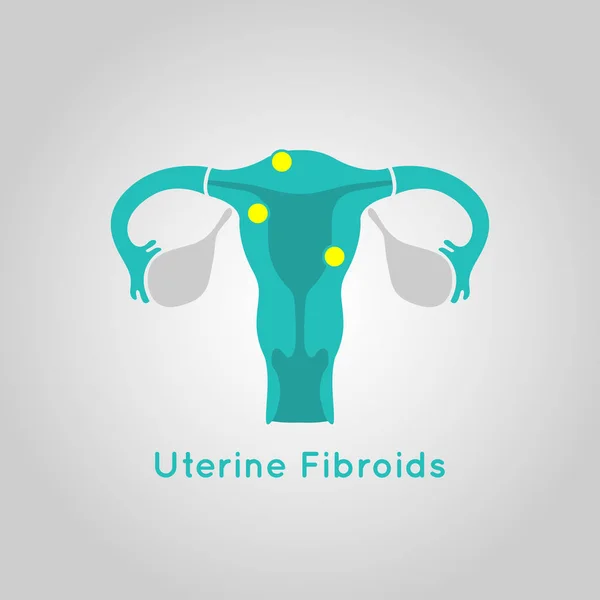 Uterine Fibroids logo vector icono diseño ilustración — Archivo Imágenes Vectoriales