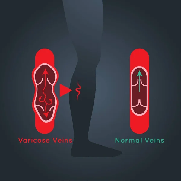 Illustrazione del logo vettoriale delle vene varicose — Vettoriale Stock