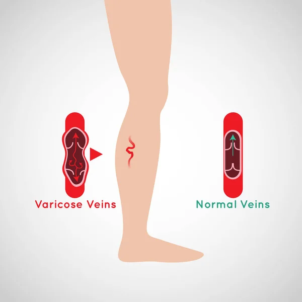 Illustrazione del logo vettoriale delle vene varicose — Vettoriale Stock