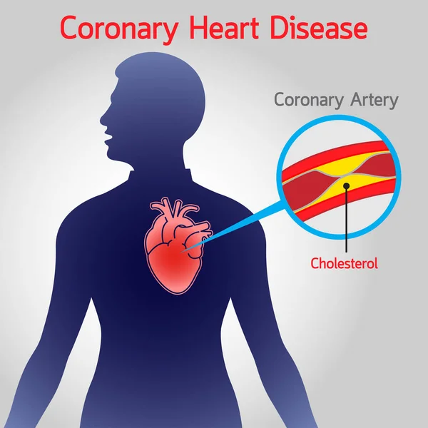 冠心病病媒标志图示 — 图库矢量图片