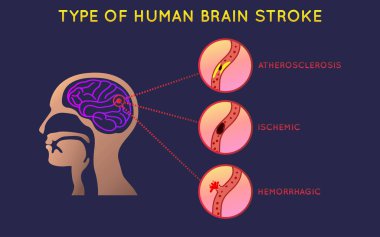 Brain Stroke icon design, infographic health, medical infographi clipart