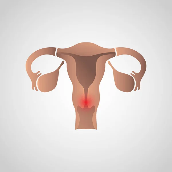 Desenho do ícone do câncer cervical, saúde infográfica. Vector illustra — Vetor de Stock
