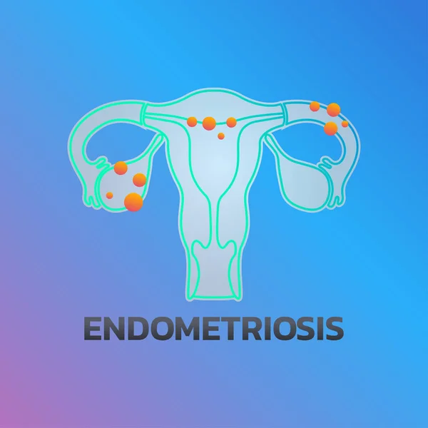 Design de ícone de endometriose, saúde infográfica. Vector illustrati —  Vetores de Stock