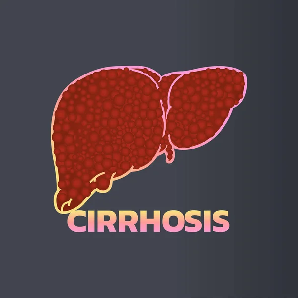 Дизайн иконок цирроза, инфографическое здоровье, медицинская инфографика . — стоковый вектор