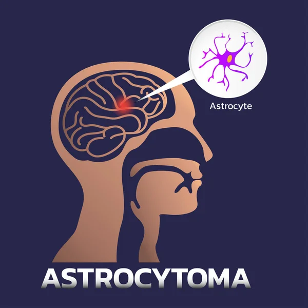 Astrocitoma iconos médicos, ilustración vectorial — Vector de stock