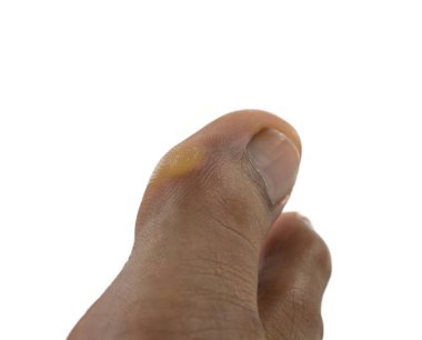 Beyaz arka planda bir adamın ayak üzerinde callcus