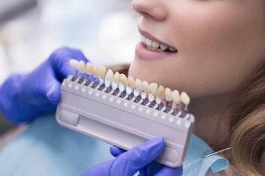 Avrupalı güzel bir kadın sağlıklı diş beyazlatıcı ile gülümsüyor. Diş bakımı konsepti. Farklı tonlarda implantlar.