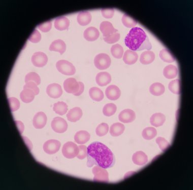 blast cells in peripheral blood images. clipart