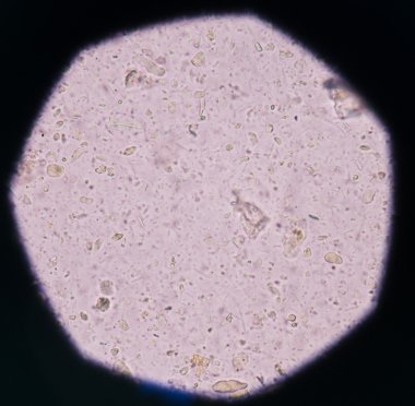 Bakteri idrar yolu enfeksiyonları.