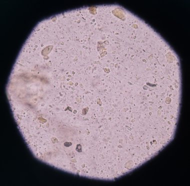 Bakteri idrar yolu enfeksiyonları.