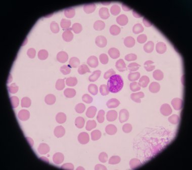 Blast hücrelerinin periferik kan görüntüler.