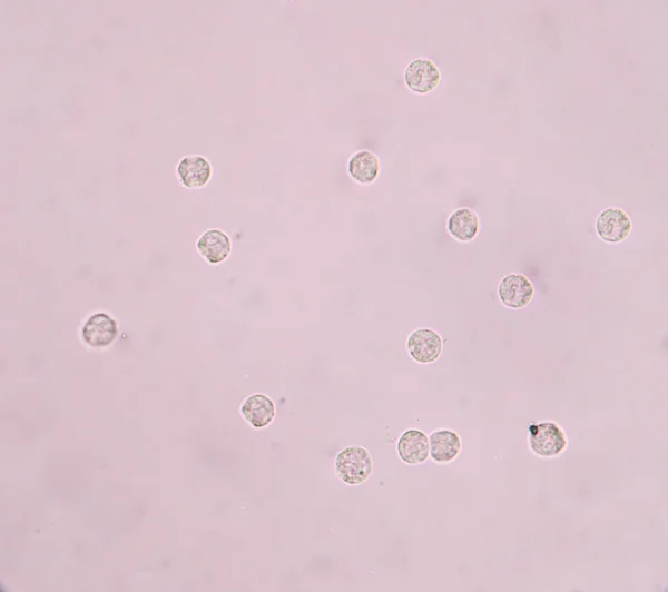 Glóbulos blancos en la orina — Foto de Stock