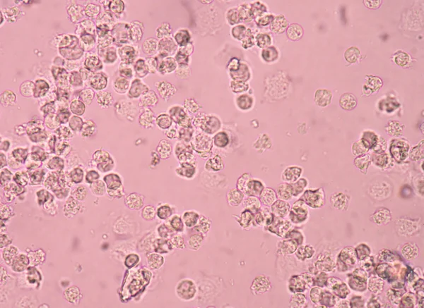 White blood cells in urine — Stock Photo, Image