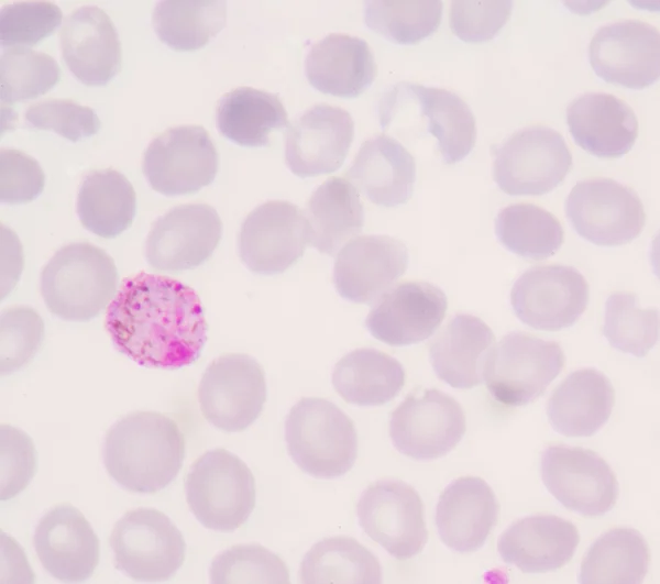 Blutfilme für Malaria-Parasiten — Stockfoto