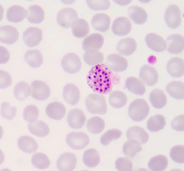 マラリア原虫の血フィルム — ストック写真